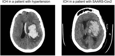 SARS-CoV-2 infection increases risk of intracranial hemorrhage